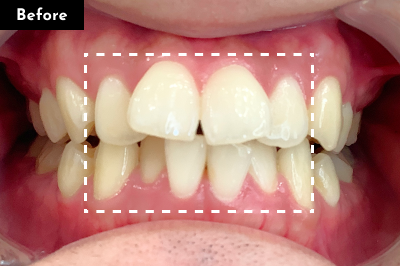 東京銀座有楽町矯正歯科の20代「上下の前歯」の矯正の症例(Before)