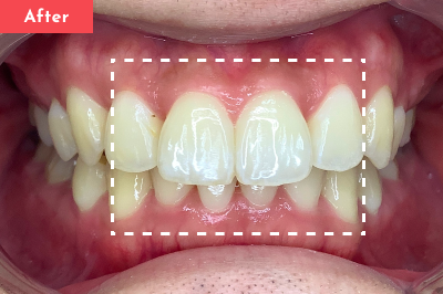 東京銀座有楽町矯正歯科の20代「上下の前歯」の矯正の症例(After)