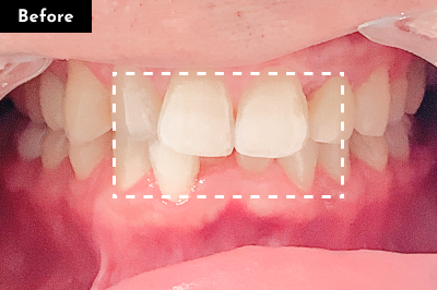東京銀座有楽町矯正歯科の50代「下の前歯」だけの矯正の症例(Before)
